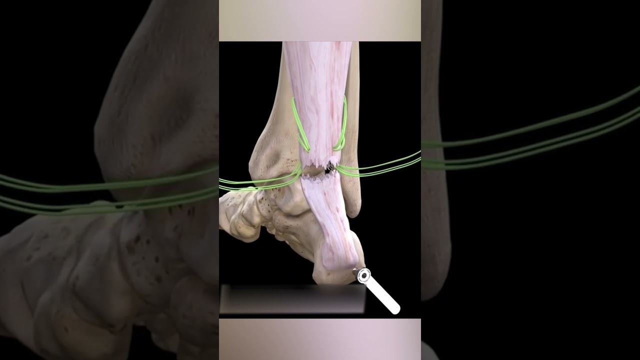 Achilles Tendon Repair 
