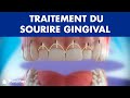 Gingivectomie  - Traitement du sourire gingival ©