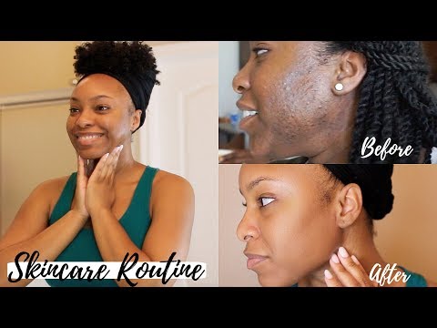 Affordable Skincare Routine | Get Rid of Acne and Dark Spots FAST!!!