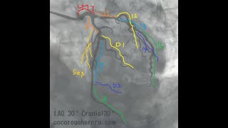 【心カテ】冠動脈の解剖とシネ画像　第５話　みんなが嫌いなCAG-Cine画像について