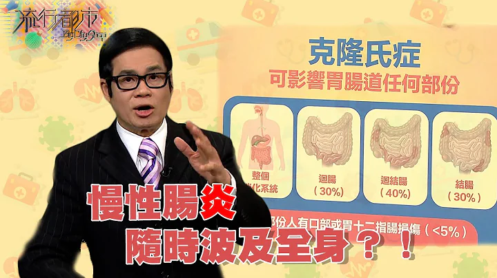 流行都市 ｜慢性腸炎隨時波及全身？！｜炎症性腸病｜克隆氏症｜潰瘍性腸炎 - 天天要聞