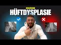 Hüftdysplasie erklärt: Ursachen, Symptome &amp; was wirklich hilft