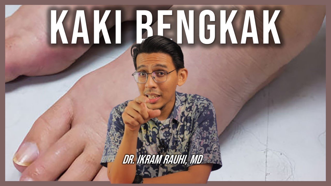 4 Punca dan Penyebab Kaki Bengkak