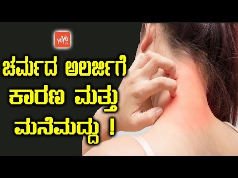 ಚರ್ಮದ ಅಲರ್ಜಿಗೆ ಕಾರಣ ಮತ್ತು ಮನೆಮದ್ದು ! | Skin Allergy Remedies in Kannada | YOYO TV Kannada Health