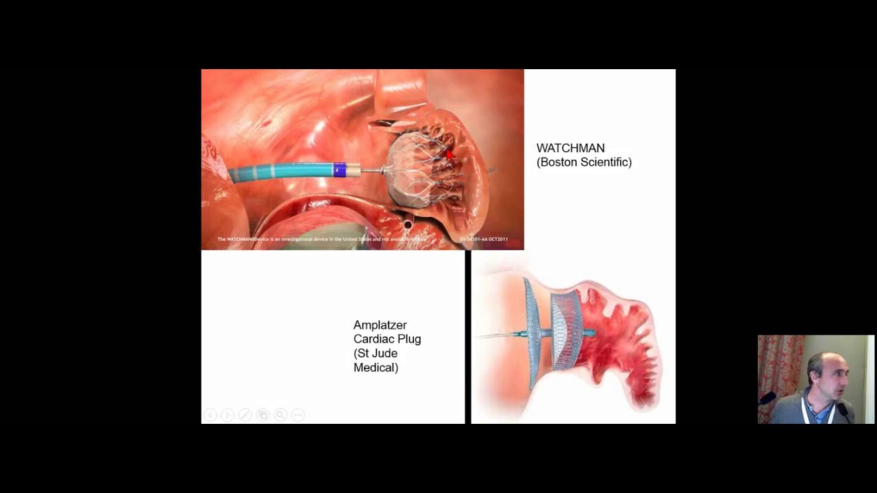 Risque hémorragique Fermeture de l’auricule gauche en pratique YouTube Risque hémorragique Fermeture de l’auricule gauche en pratique YouTube