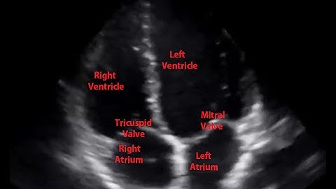 Echocardiogram Apical Four Chamber View - Loop