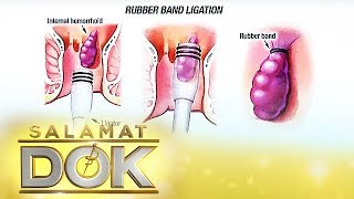 Salamat Dok: Dr. Fuentes discusses the treatment and surgical procedure for hemorrhoids or almuranas