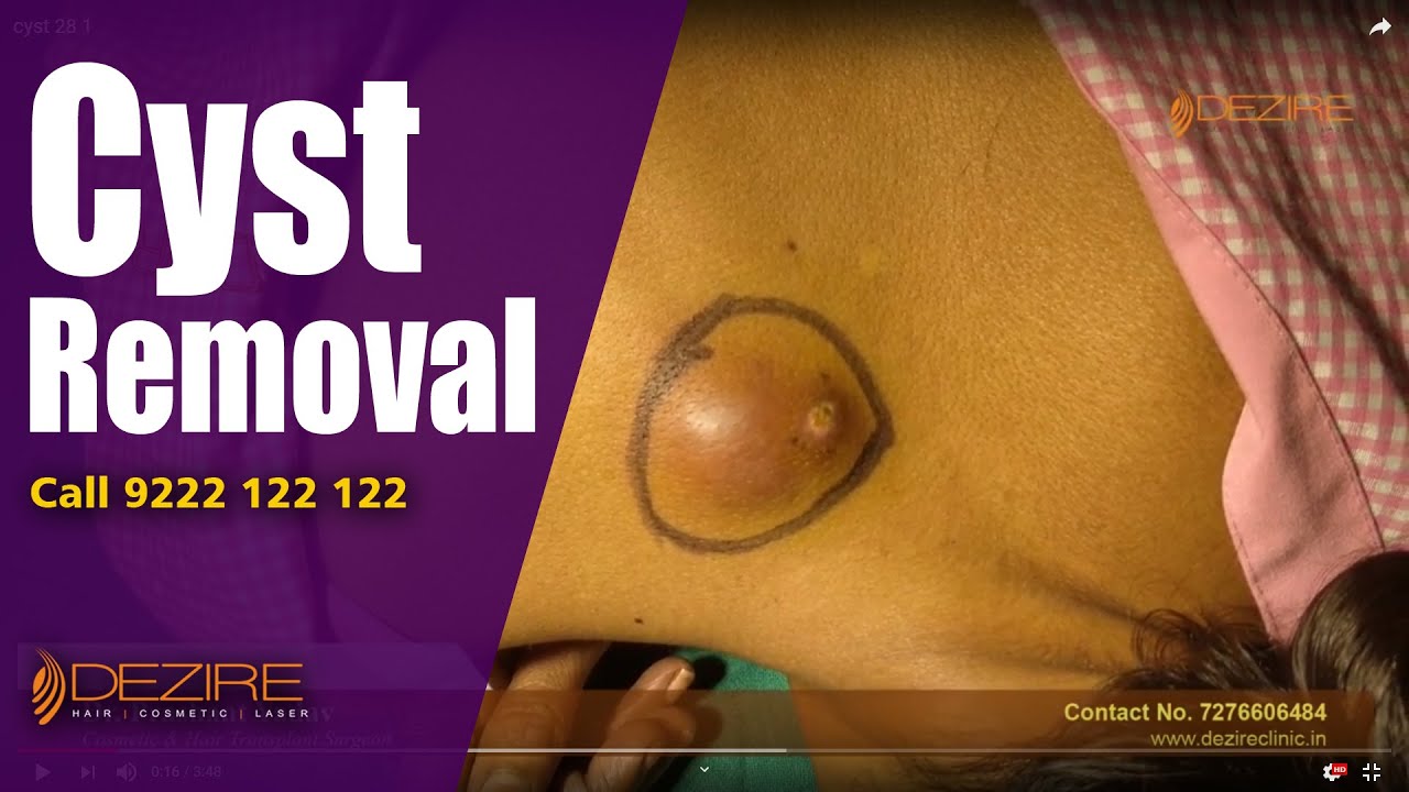 Best Sebaceous Cyst Removal Treatment in Hindi | Dezire Clinic - Pune | Gurgaon | Delhi | Bengalor |