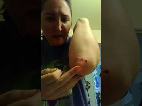 Dermatomyositis Day 2 - YouTube