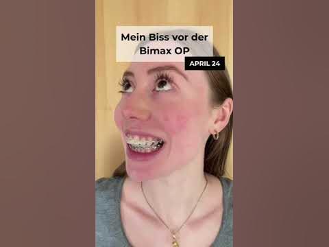 Kieferfehlstellung Überbiss vor Bimax Operation - YouTube