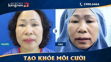 Nụ cười hoàn hảo: Phẫu thuật Tạo Khóe Môi Cười tại Kangnam
