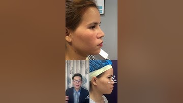 Phân biệt nâng mũi cấu trúc và nâng mũi bọc sụn!