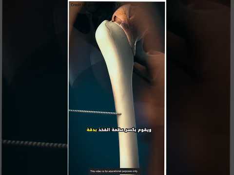 كيف يتم زيادة الطول جراحيا هل تستحق المخاطرة