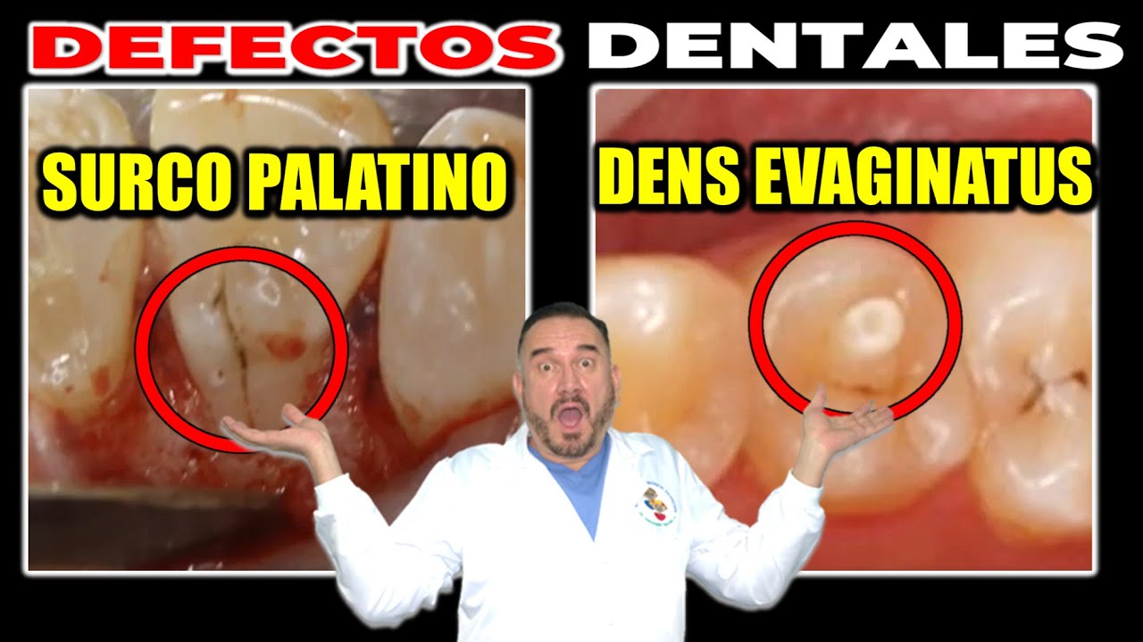 ANOMALÍA SURCO PALATINO (DESARROLLO DENTAL 𝗗𝗘 FORMA) YouTube