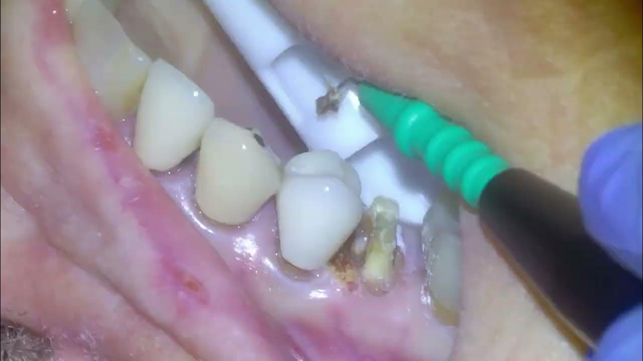 [26] Major decay under crown leads to root canal YouTube