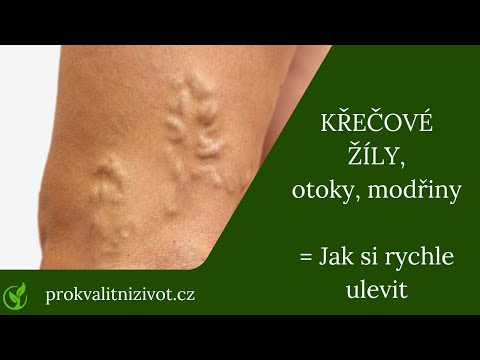 Video: Jak léčit křečové žíly na nohou u žen