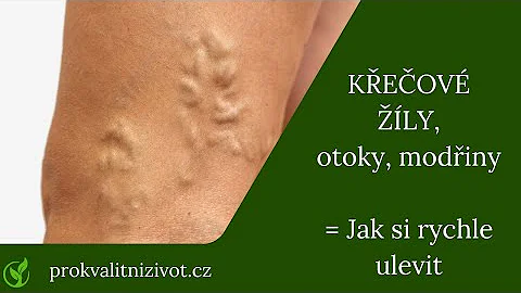 Jak urychlit hojení modřiny?