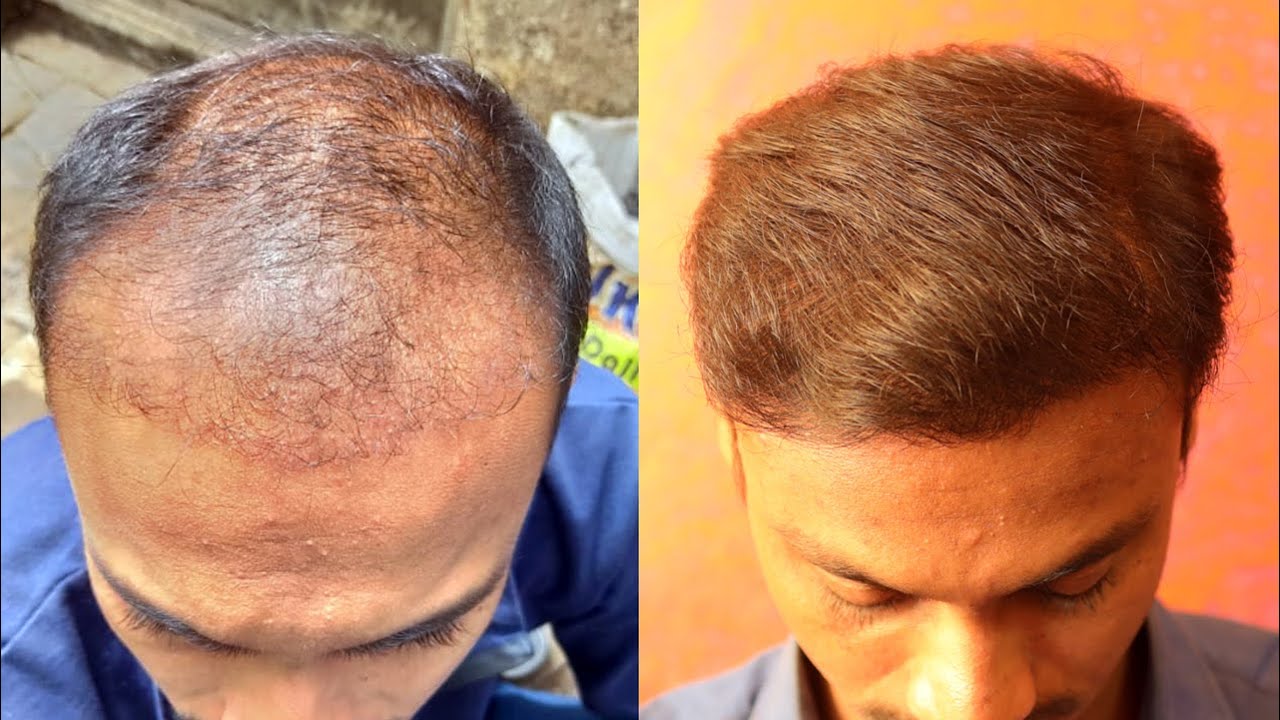 🆕best Fue Hair Transplant Aurangabad 👉 Hair Transplant Clinic