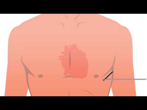 Video: Braukšana Pēc Defibrilatora Implantācijas: Valsts Mēroga Anketas Izstrāde Un Izmēģinājuma Rezultāti