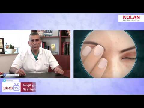 Op. Dr. Savaş Baydar - Alerjik Göz Hastalığı Nedir? Belirtileri Nelerdir? Nasıl Tedavi Edilir?