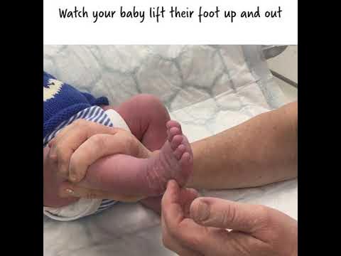 Tickle and Move - Clubfoot Treatment