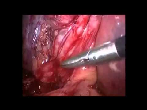 Laparoscopic cholecystectomy with Distorted Callots at Sunrise Hospital Delhi