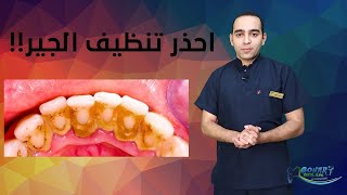 كيفية تنظيف الجير على الاسنان | عيوب و مميزات ازالة الجير ( التكلسات ) !!