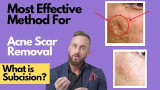 How To Treat DEEP ACNE SCARS | What is SUBCISION? screenshot 3