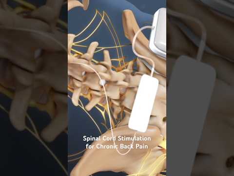 Spinal Cord Stimulation