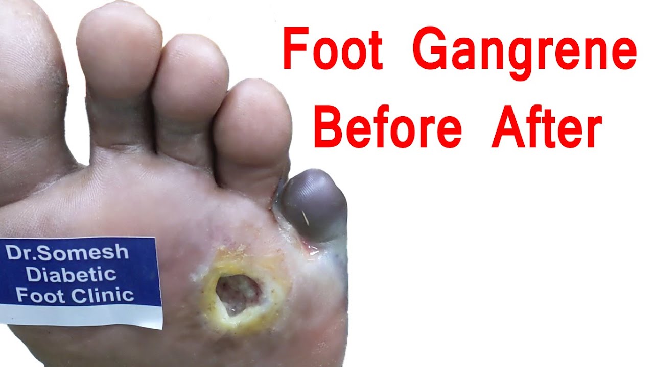 Gangrene Toe Amputation Before After Video YouTube