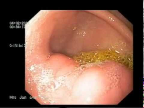 An upper GI (gastrointestinal)An upper GI (gastrointestinal)endoscopyAn upper GI (gastrointestinal)A. 