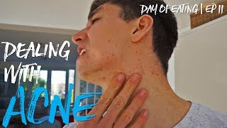 DEALING WITH ACNE | Day Of Eating 11
