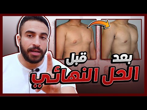 gynecomastia - علاج التثدي عند الرجال - انواعه و وطرق علاجه بدون جراحة