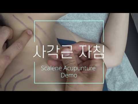 전사각근, 중사각근의 자침