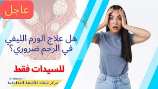 علاج أورام الرحم الليفية وهل علاج الورم الليفي في الرحم ضروري؟ و رسالة هامة جداً للسيدات