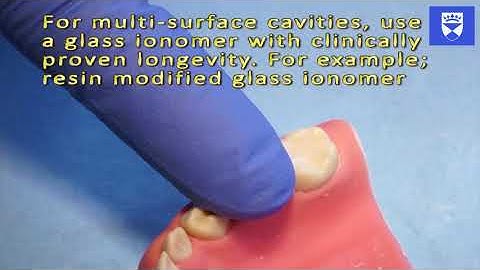 A technique for Atraumatic Restorative Treatment (ART). Part2: Restoration