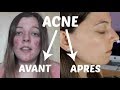 Acne  mon exprience et traitements naturels