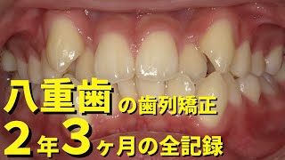 【亀裂の八重歯】 八重歯・ガチャ歯・ガタガタの歯列矯正・表側矯正│小臼歯4本