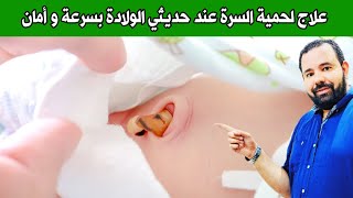 لحمية السرة عند المواليد و الرضع | علاج لحمية السرة عند الاطفال حديثي الولادة بالملح