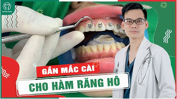 QUY TRÌNH GẮN MẮC CÀI NIỀNG RĂNG DIỄN RA NHƯ THẾ NÀO | Chỉnh nha tại Nha khoa Italiano |