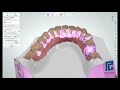 Férula de Michigan inferior, diseño 3Shape y impresión 3D con Formlab - DlCasas prótesis dental