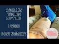 Achilles Tendon Rupture | 1 Week | POST SURGERY | 2021