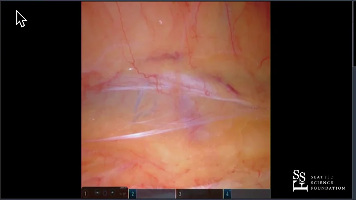 Retroperitoneal Robotic Partial Nephrectom by Jame...