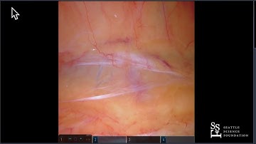Retroperitoneal Robotic Partial Nephrectom by James Porter, MD