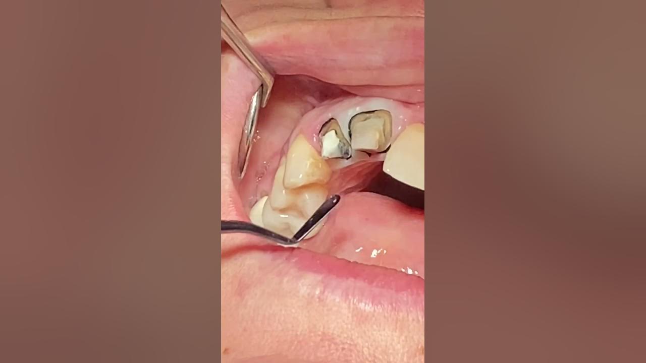 PVS impression technique or crowns using full arch triple tray from Premier Dental YouTube
