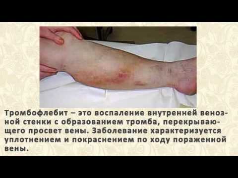 Варикозное расширение вен кишечника