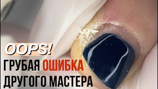 КАК МНЕ ЗАПОРОЛИ НОГТИ. Педикюр от другого мастера. Подногтевые мозоли. Вростание ногтей