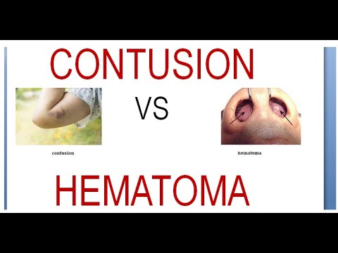 Surgery 011 Wound Contusion Hematoma Difference Vs Compare Between