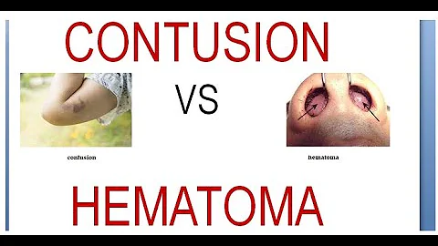 ¿Cuál es la diferencia entre un hematoma y una contusión?