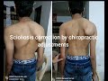 Scioliosis correction by chiropractic adjustments